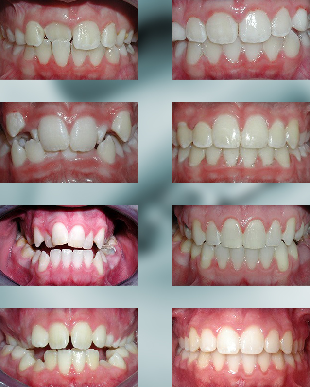 Michael-Riordan-Orthodontics-Before-After-2