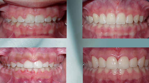 Michael-Riordan-Orthodontics-laser-gum-recontouring-BandA