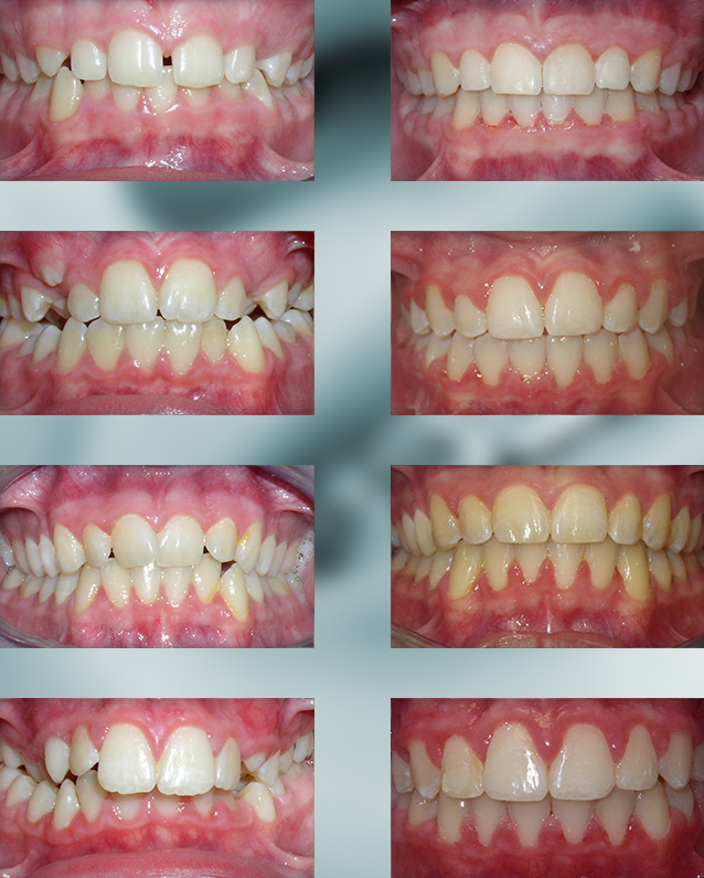 Midline Teeth
